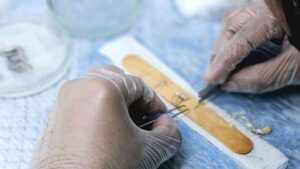 Iskrena iskustva i usporedba FUE, FUT i DHI metoda presađivanja kose