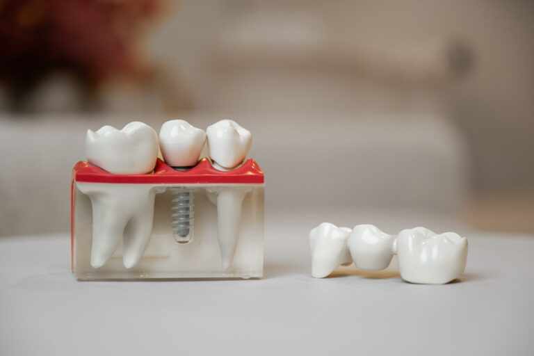 ISKUŠENJA S IMPLANTATIMA: ŠTO TREBA ZNATI