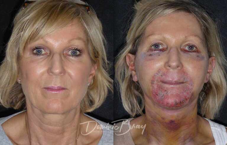 ISKUSTVA SA CO2 LASEROM