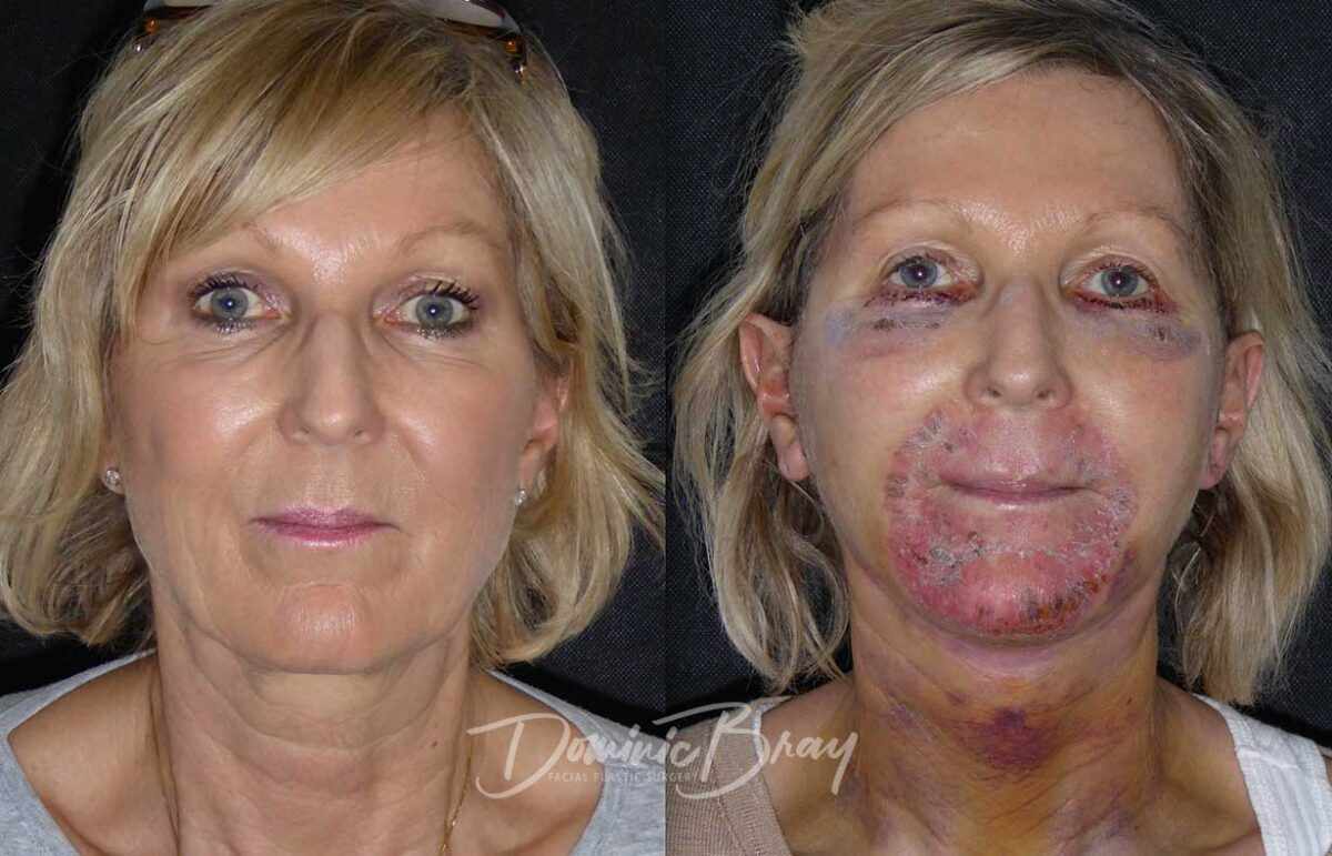 ISKUSTVA SA CO2 LASEROM